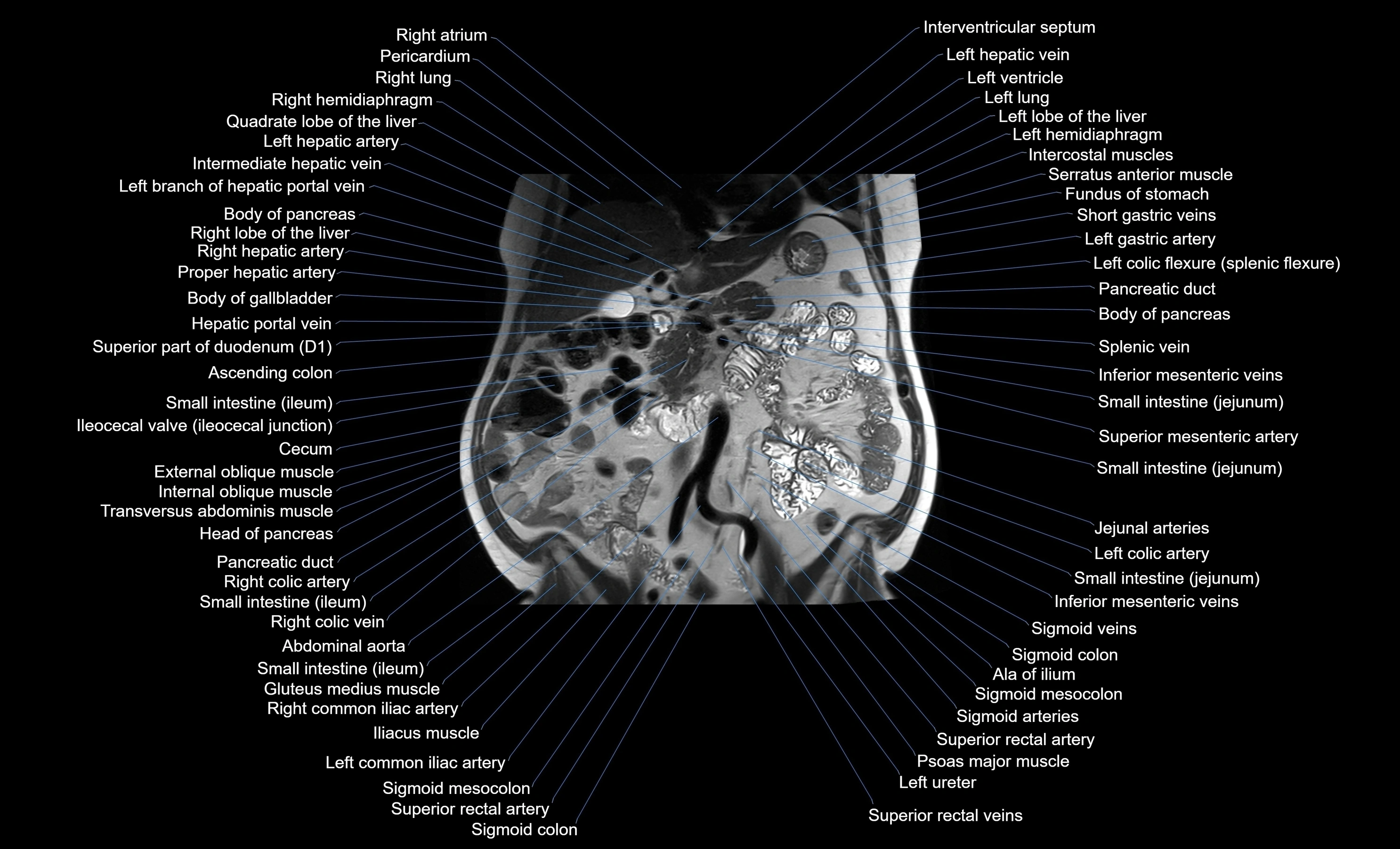 MRI Abdomen coronal labelled cross sectional anatomy radiology  image-img-00001-00027.webp